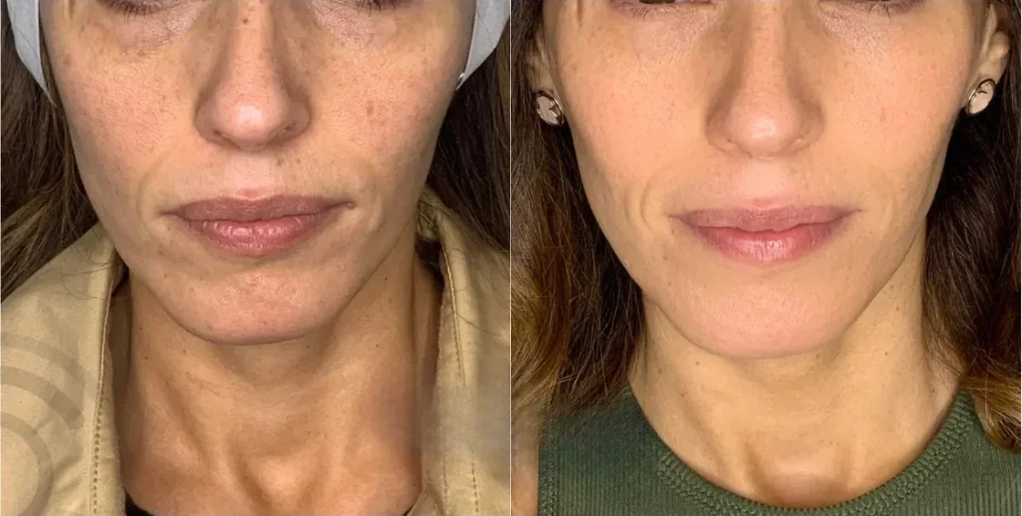 Dermapen Skinbooster